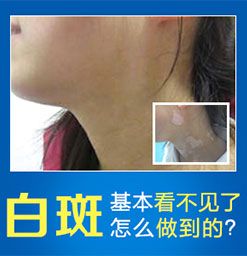 郑州西京医院介绍三种常见的白斑的诊断方法
