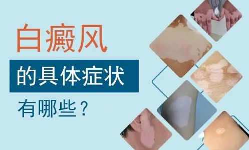 白癜风的发病期有多长？